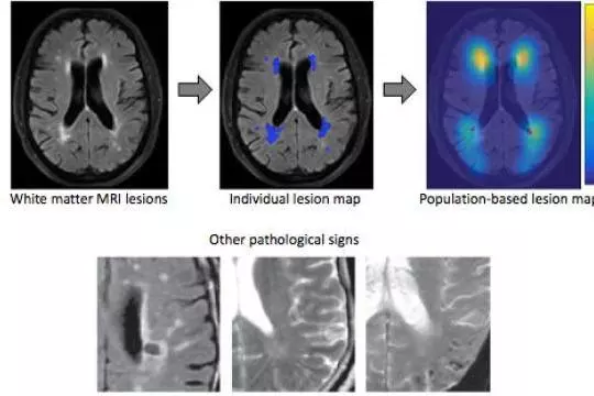Case study: 2015 CDT student Vaanathi Sundaresan is working on automated analysis of medical images